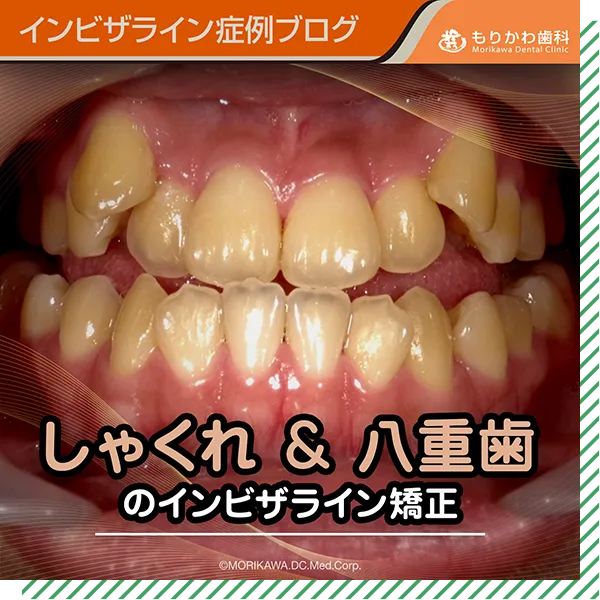 反対咬合（しゃくれ）、八重歯の症例