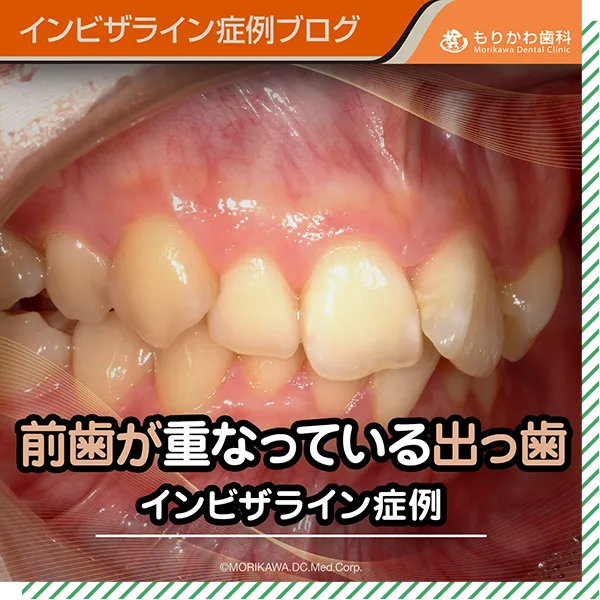前歯が重なっている出っ歯のインビザライン症例