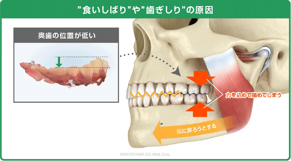 ”食いしばり”や”歯ぎしり”の原因
