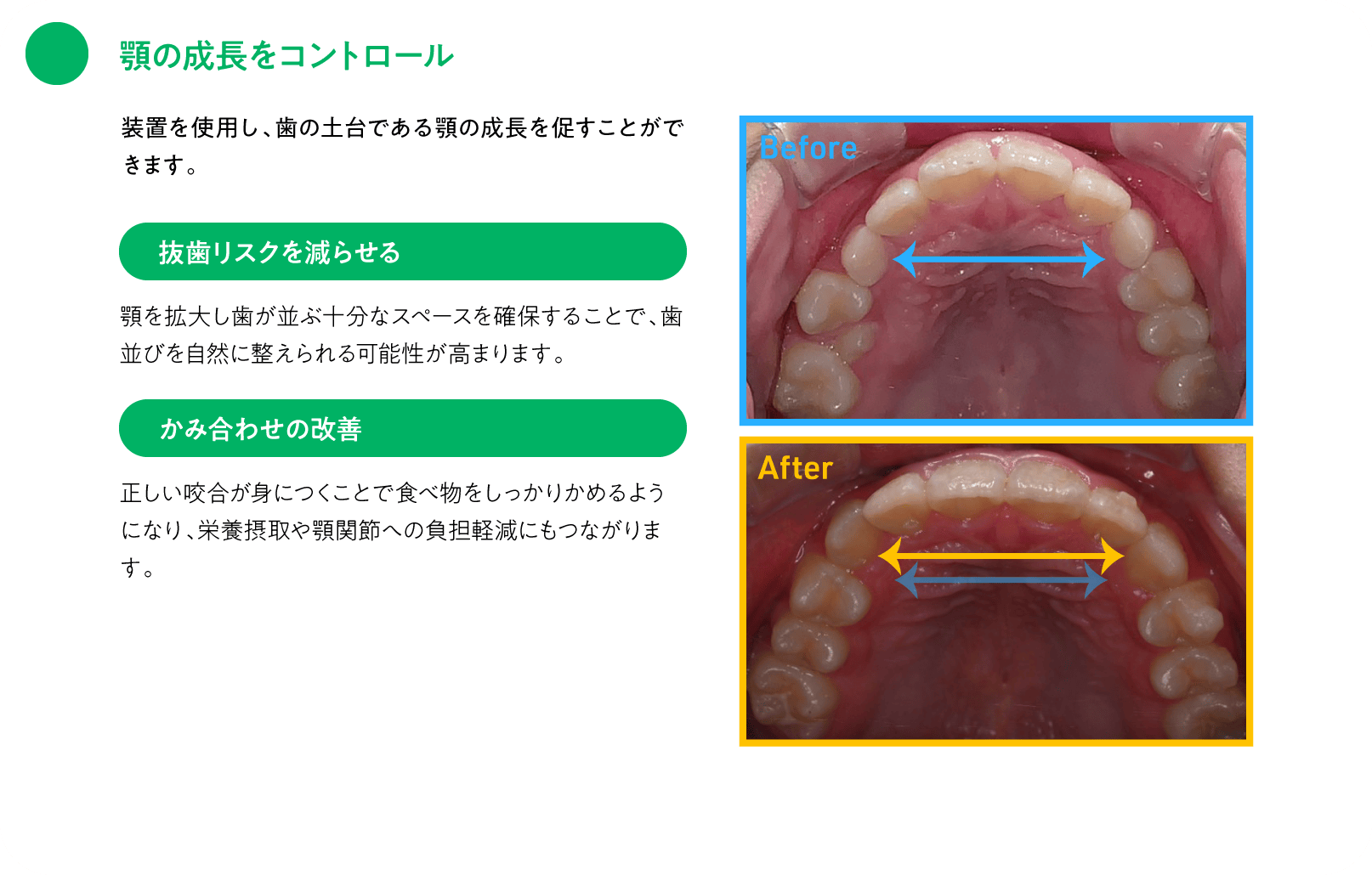 顎の成長をコントロール