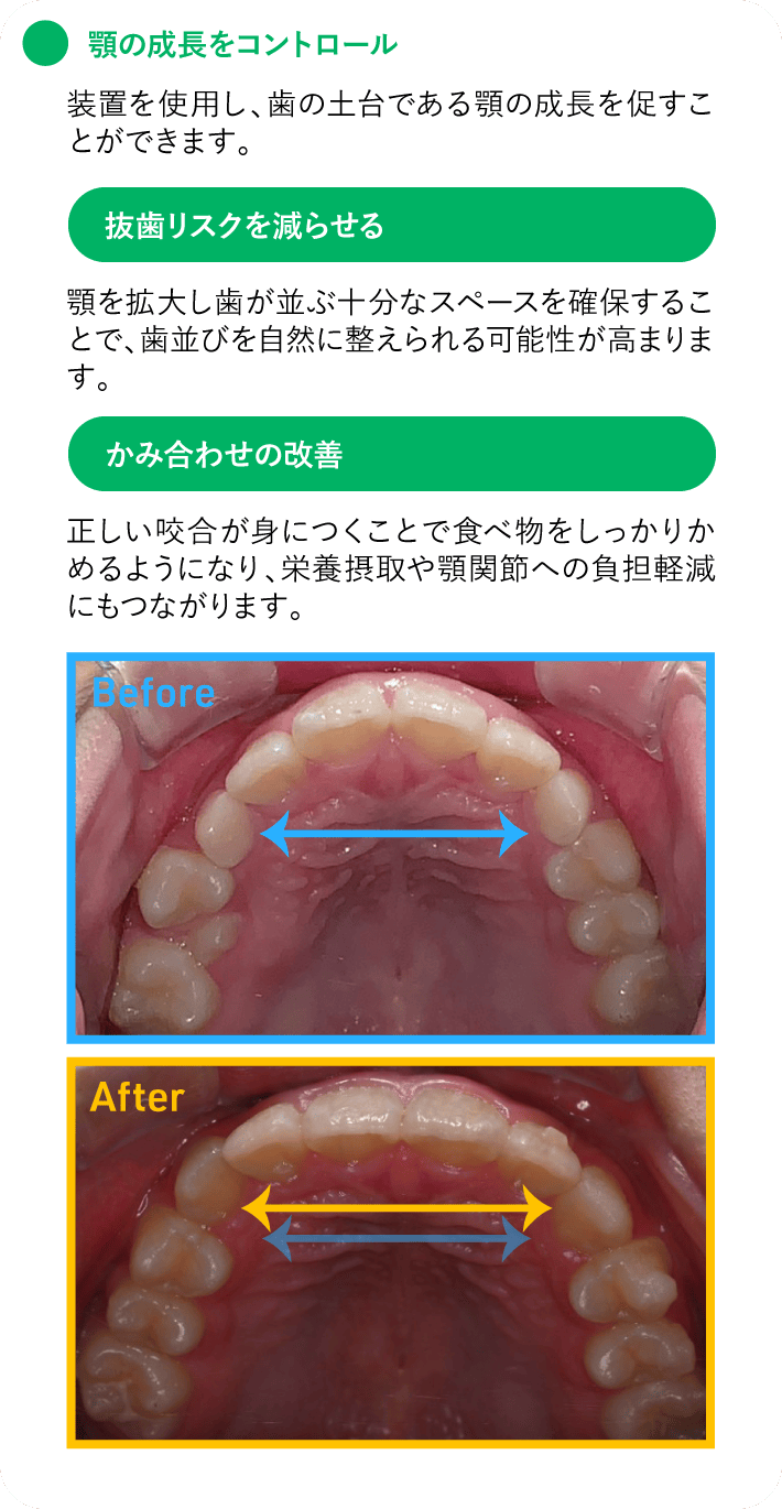 顎の成長をコントロール