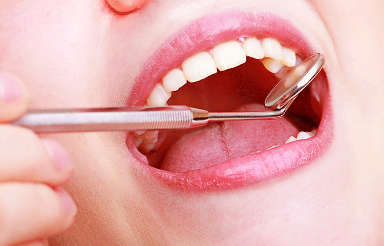 虫歯の原因は口の中の細菌