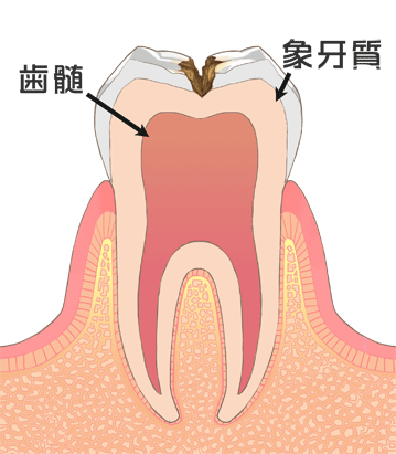 C２　歯の内部まで進行した虫歯