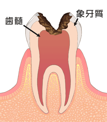 C３　神経まで進行した虫歯