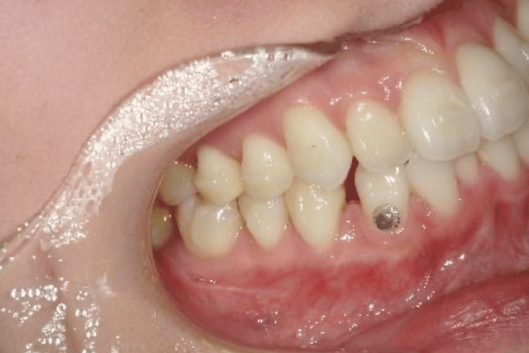 八重歯