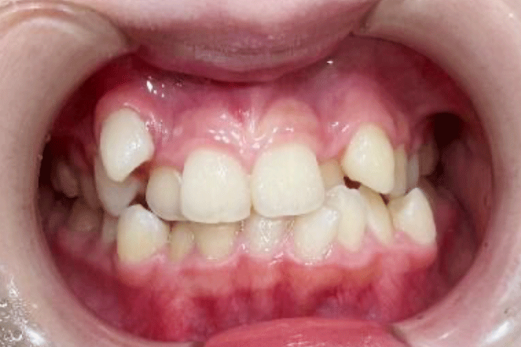 八重歯