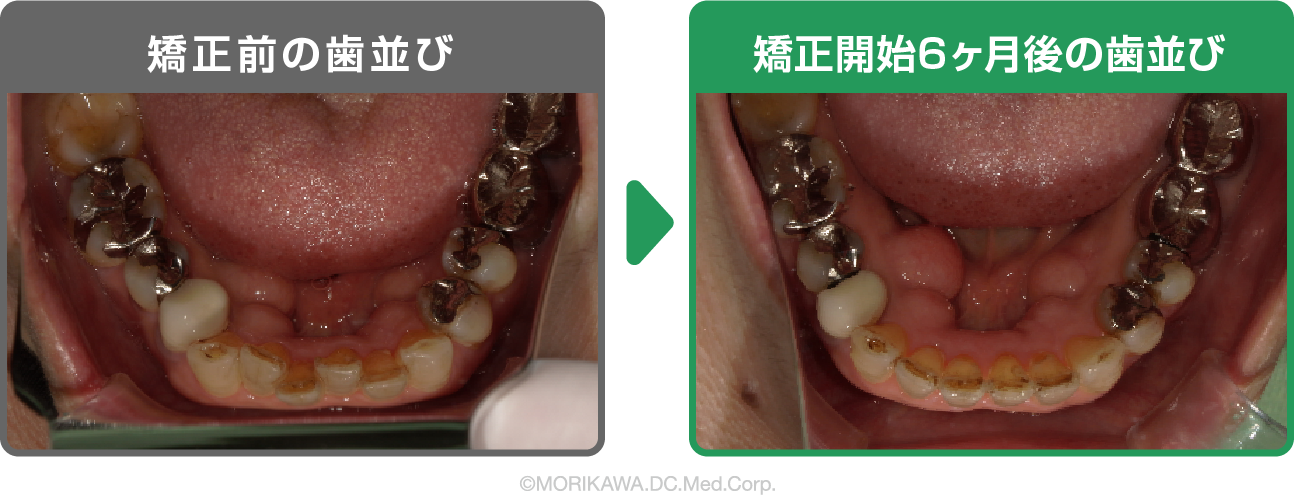 八尾市　歯医者　矯正開始６ヶ月後の歯並び