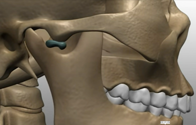 顎が後ろに下がることで関節の後ろには耳介側頭神経