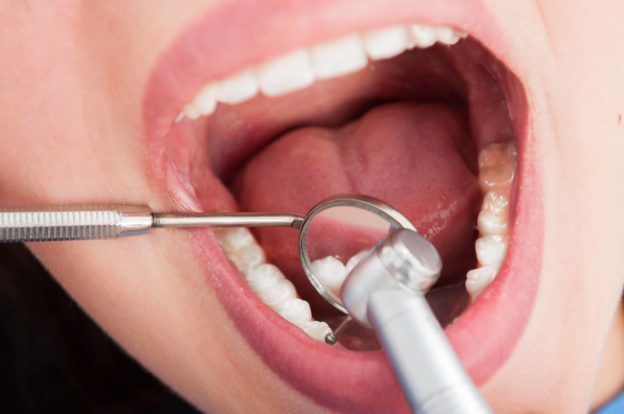 歯の虫歯治療を受ける女性の口元