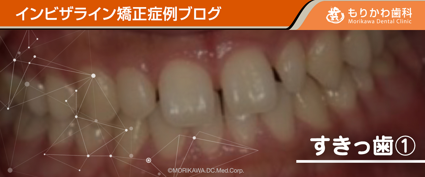症例ブログ-すきっ歯1