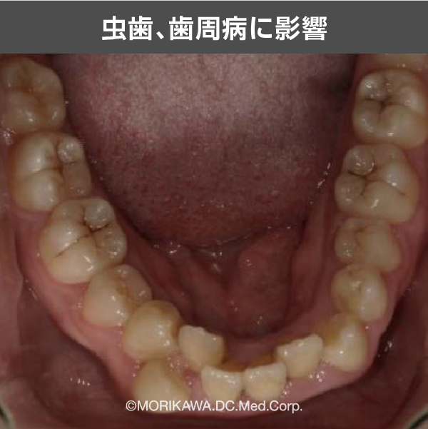 虫歯、歯周病に影響