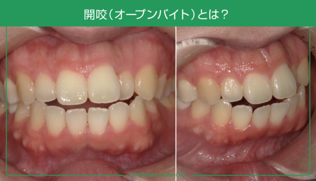 開咬(オープンバイト)ってどんな状態?