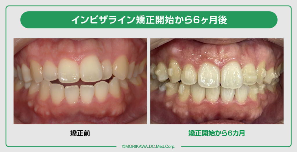 開咬(オープンバイト)ってどんな状態?