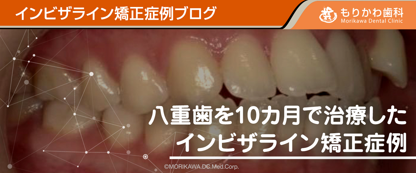 八重歯を10カ月で治療したインビザライン矯正症例