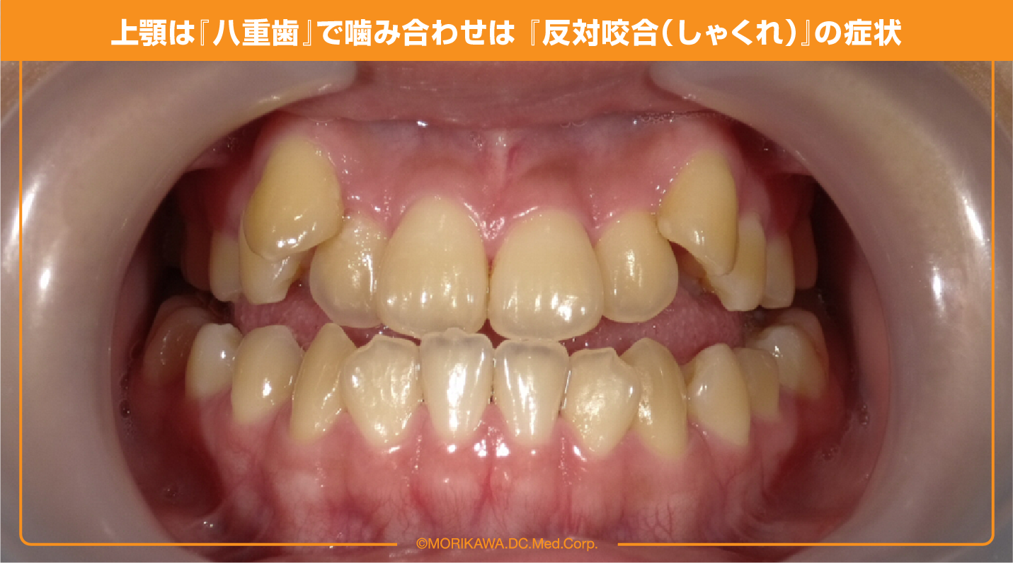 上顎は『八重歯』で噛み合わせは 『反対咬合（しゃくれ）』の症状