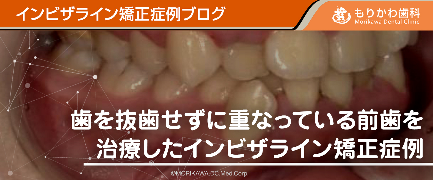 歯を抜歯せずに重なっている前歯を治療したインビザライン矯正症例