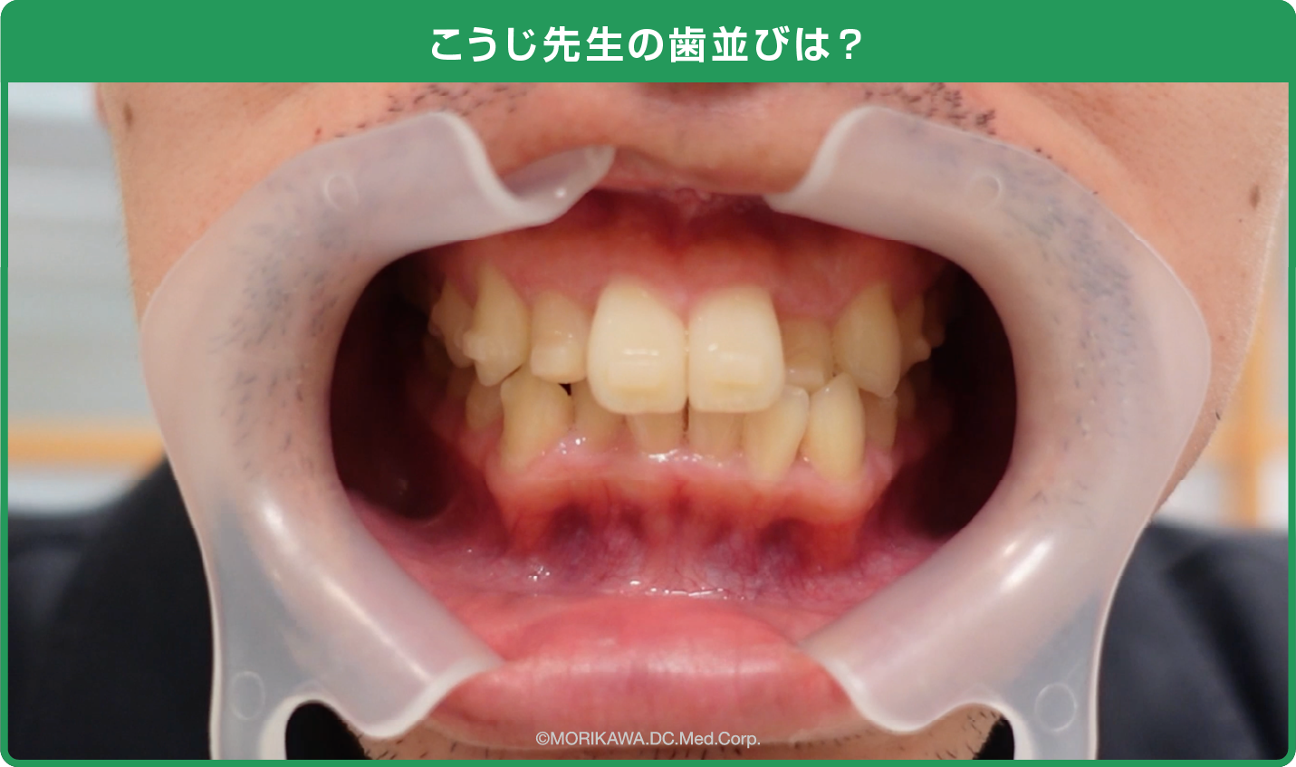 こうじ先生の歯並びは？