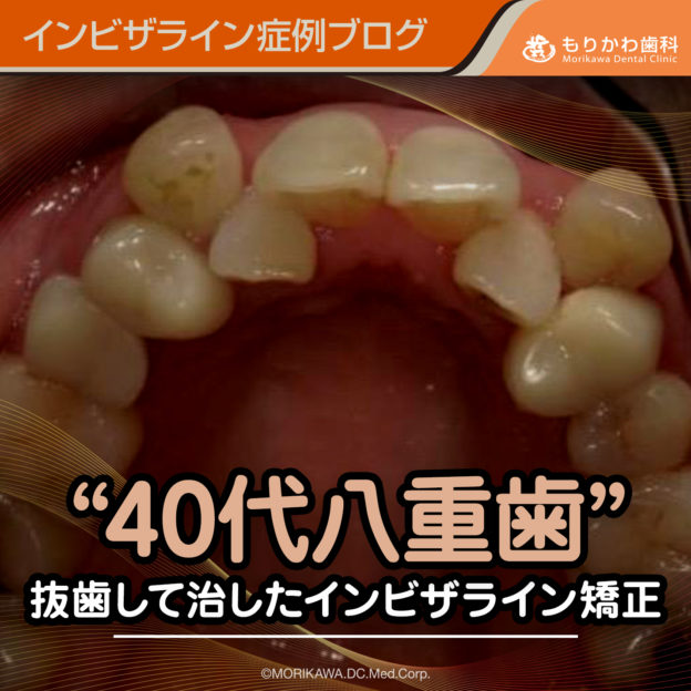 “40代八重歯“-抜歯して治したインビザライン症例