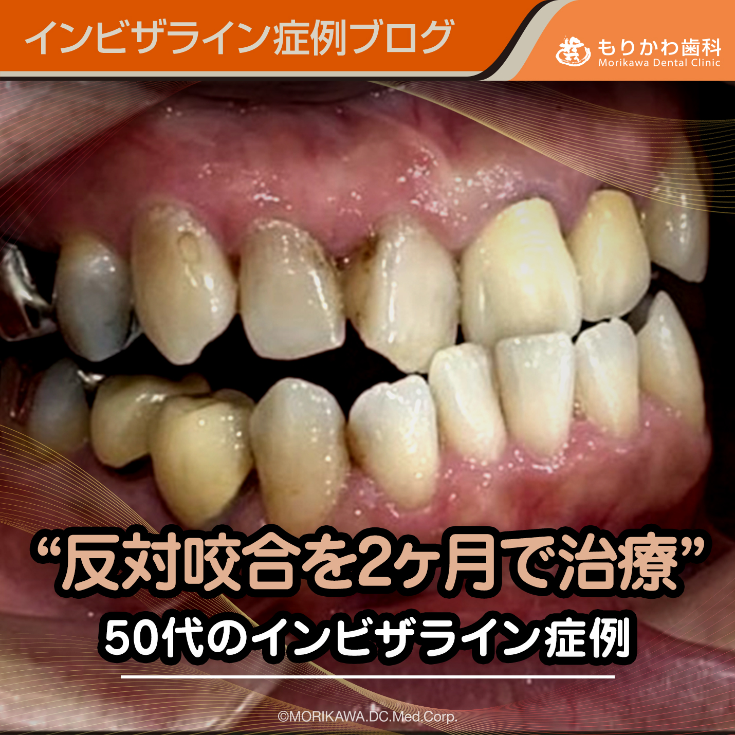 反対咬合を2ヶ月で治療した50代のインビザライン症例
