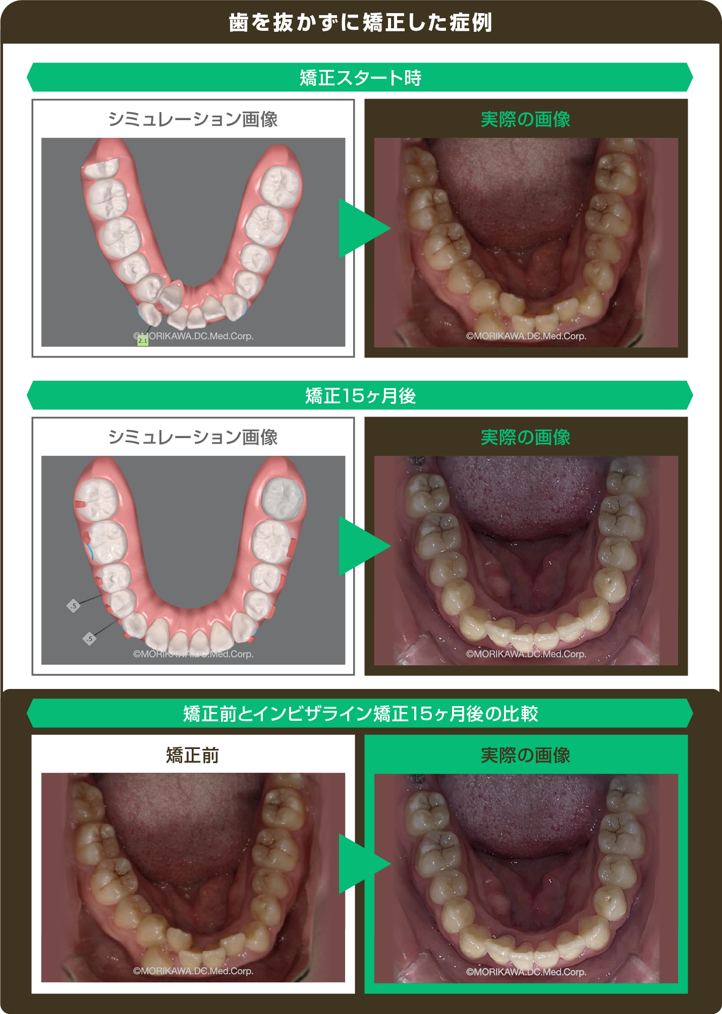 歯を抜かずに矯正した症例