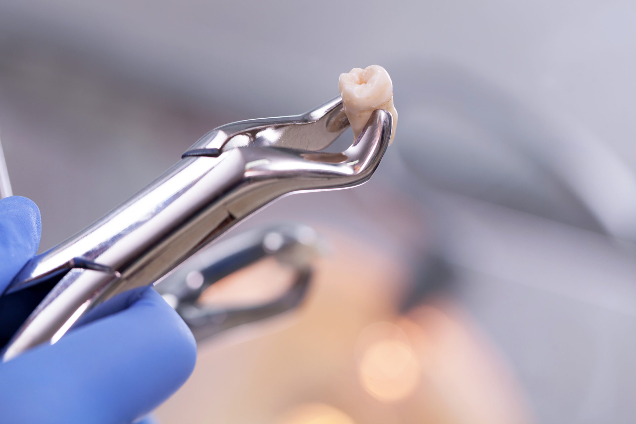 歯科医院で抜歯された歯を拡大する