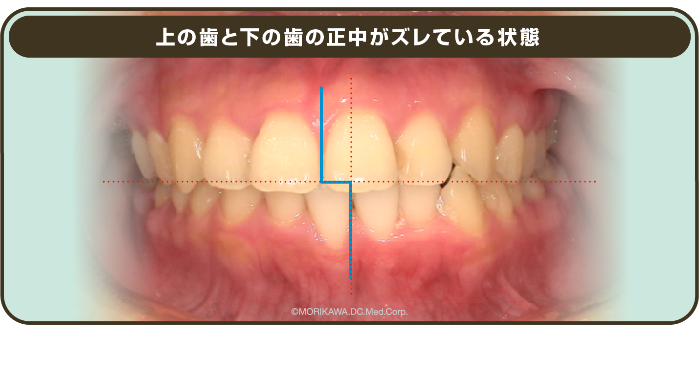 上の歯と下の歯の正中がズレている状態