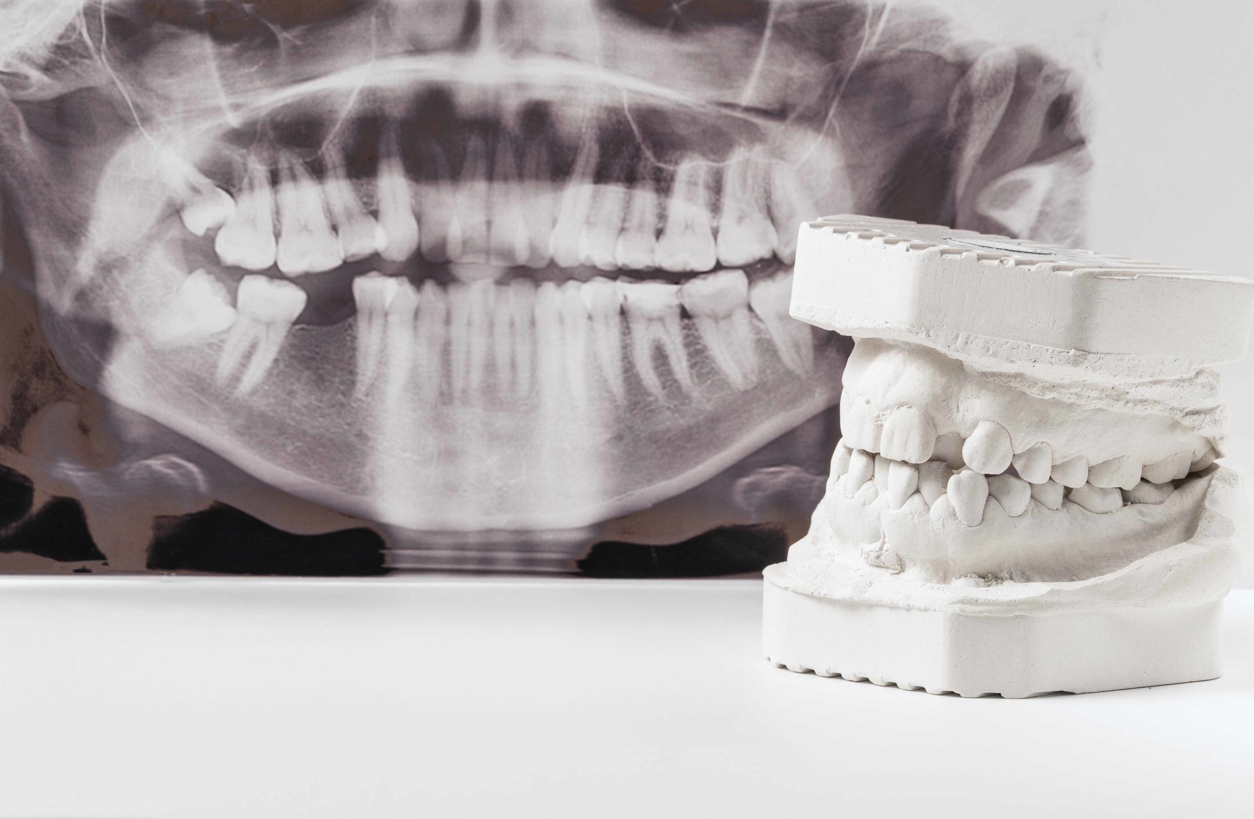 歯のレントゲン写真と歯の模型
