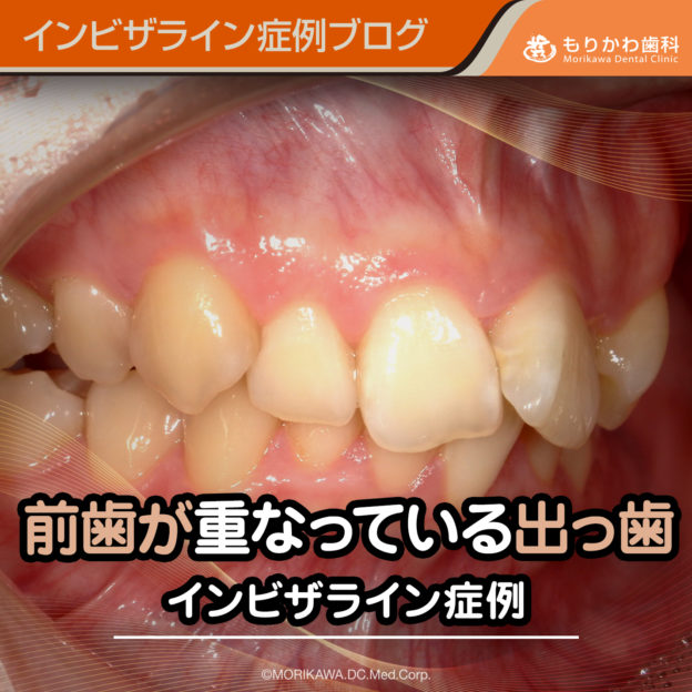 前歯が重なっている出っ歯のインビザライン症例