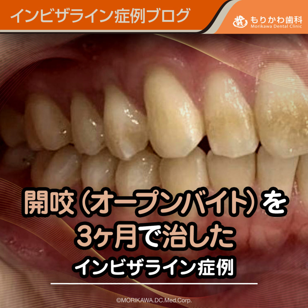 開咬(オープンバイト)を3ヶ月で治したインビザライン矯正症例