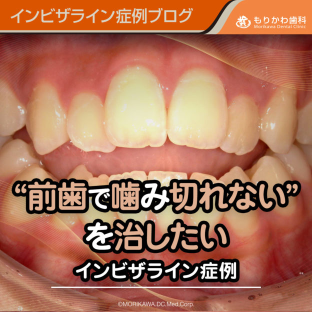 前歯で噛み切れないを治したいインビザライン症例
