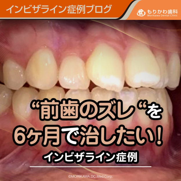 “前歯のズレ“を6ヶ月で治したい！