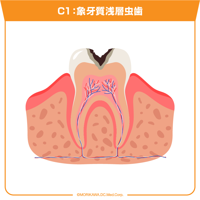C1：象牙質浅層虫歯