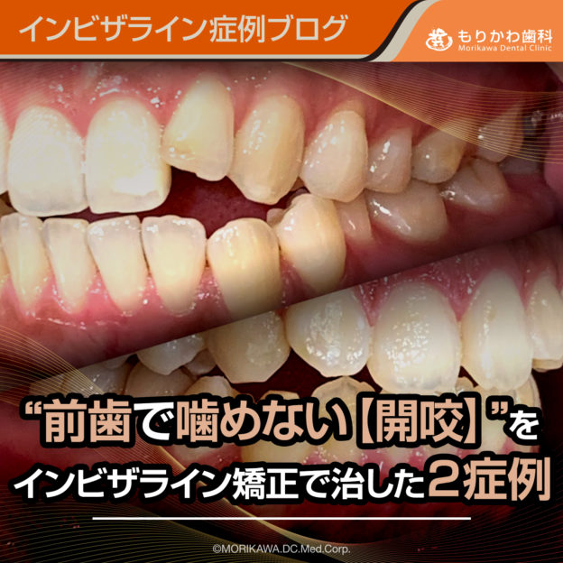 前歯で噛めない【開咬】をインビザライン矯正で治した２症例