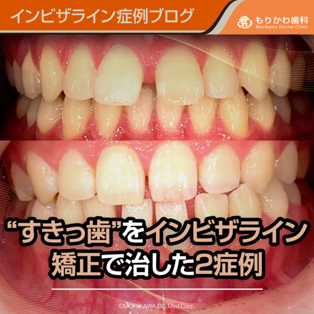 すきっ歯をインビザライン矯正で治した２症例