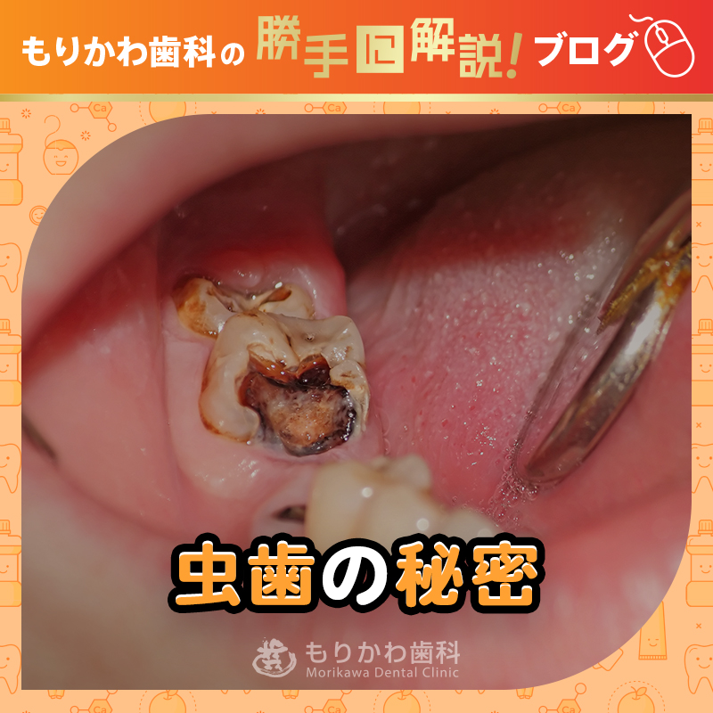 虫歯の秘密を詳しく解説！