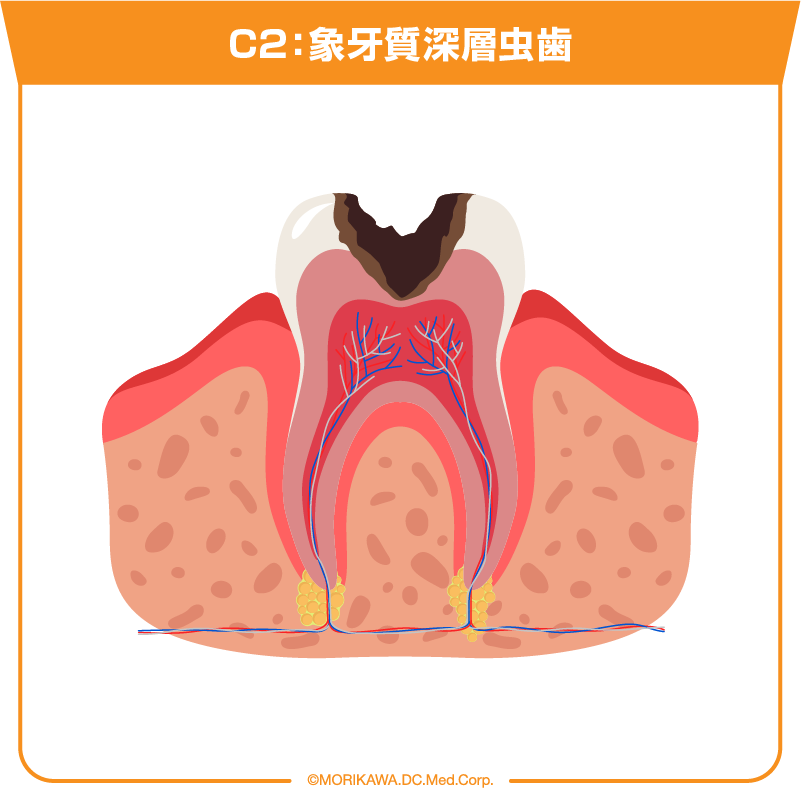 C2：象牙質深層虫歯