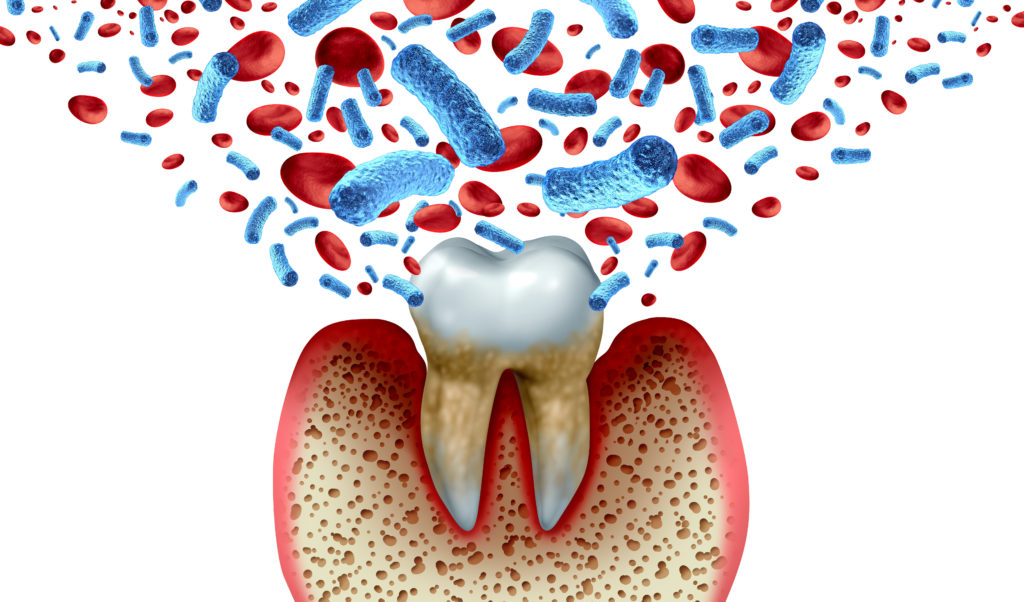 歯周病の原因の細菌のイメージ