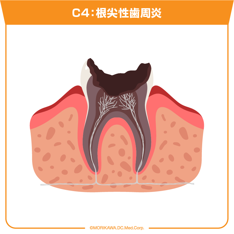 C4：根尖性歯周炎
