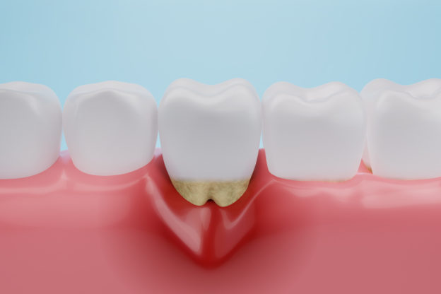 歯周病が原因で歯がぐらつくイメージ