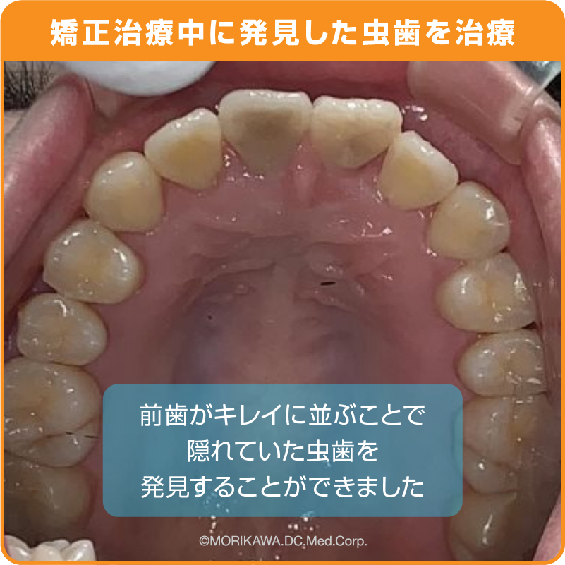 矯正治療中に発見した虫歯を治療