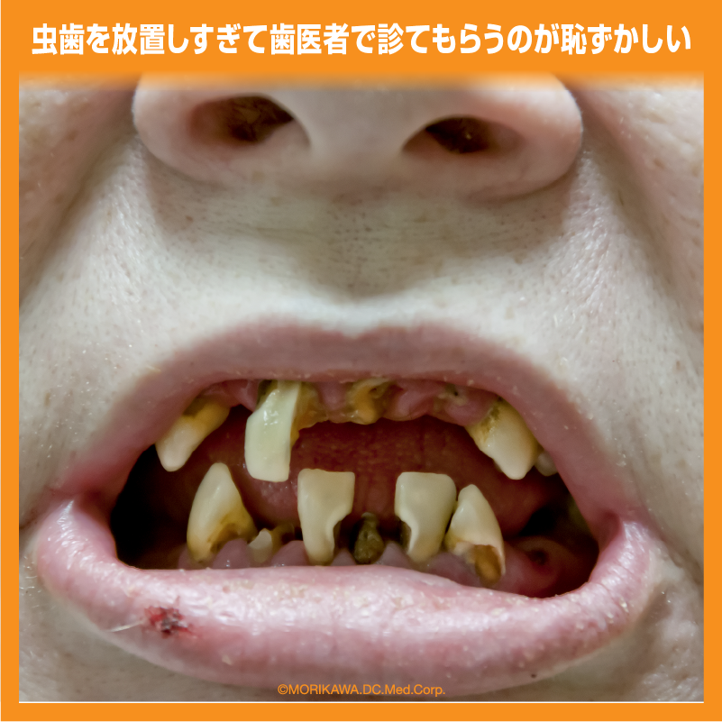 虫歯を放置しすぎて歯医者で診てもらうのが恥ずかしい