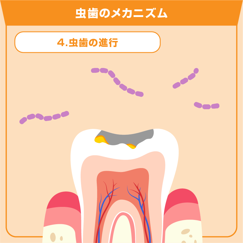 4.虫歯の進行