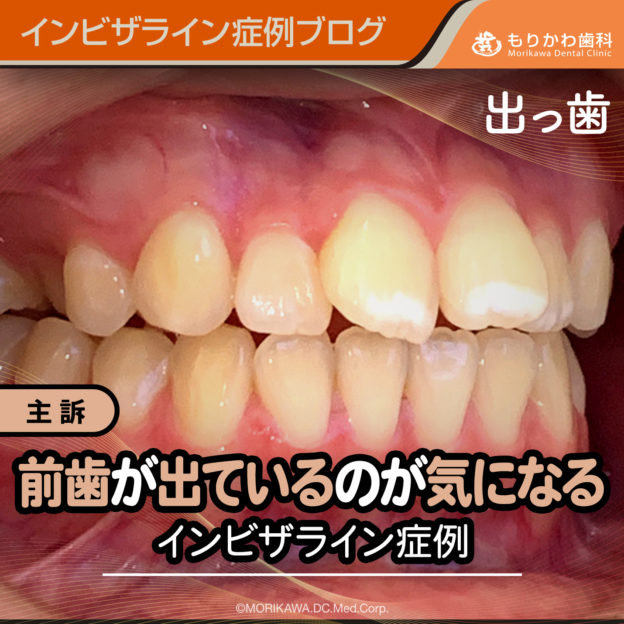 前歯が出ているのが気になるインビザライン症例