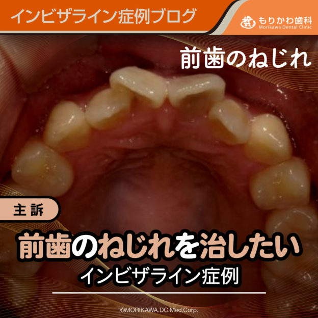 前歯のねじれを治したいインビザライン症例