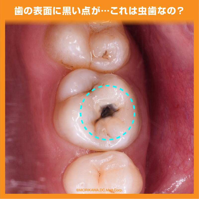 歯の表面に黒い点が…これは虫歯なの？