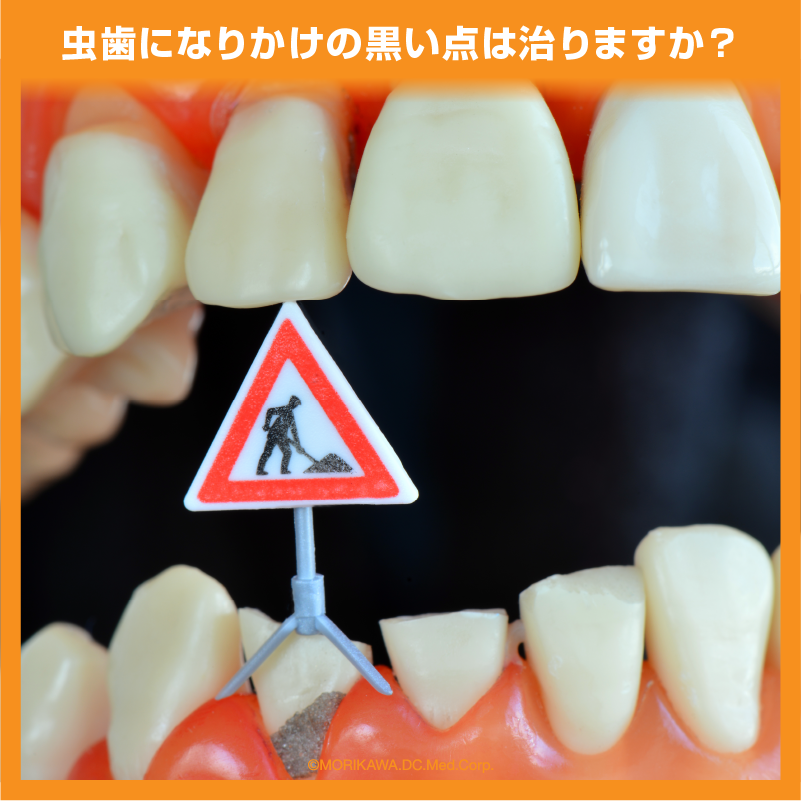 虫歯になりかけの黒い点は治りますか？