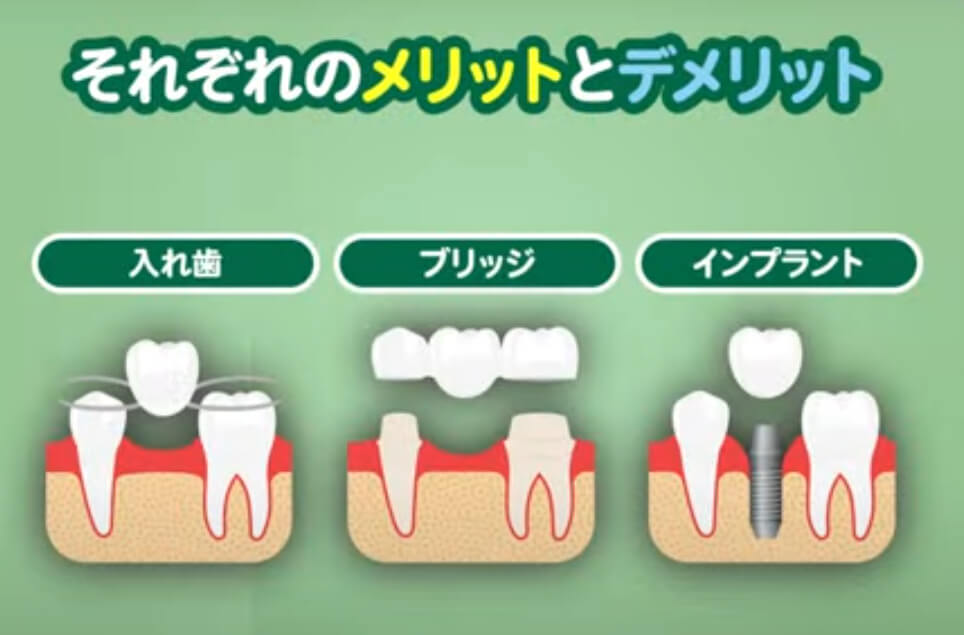 歯が欠損したときの3つの治療法