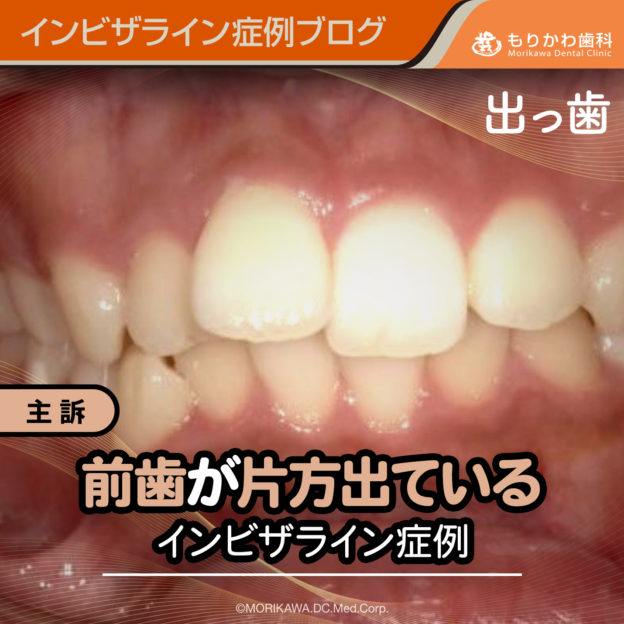 前歯が片方出ているインビザライン症例