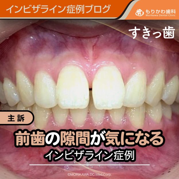 前歯の隙間が気になるインビザライン症例