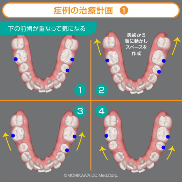 【ガタガタ】主訴「下の前歯が重なって気になる」インビザライン症例